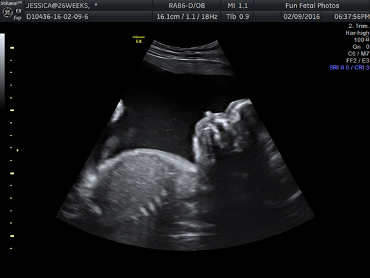 Fun Fetal Photos 2D Ultrasound prenatal imaging