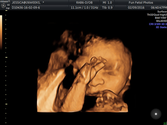 Fun Fetal Photos 3D Ultrasound prenatal imaging