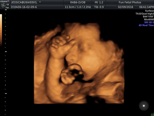 Fun Fetal Photos 3D Ultrasound prenatal imaging