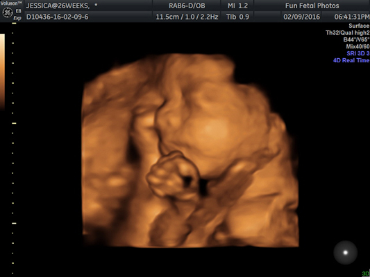 Fun Fetal Photos 3D Ultrasound prenatal imaging