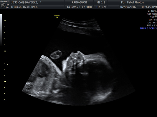 Fun Fetal Photos 2D Ultrasound prenatal imaging