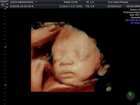 Fun Fetal Photos 3D Ultrasound prenatal imaging