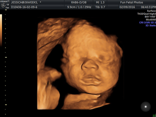 Fun Fetal Photos 3D Ultrasound prenatal imaging