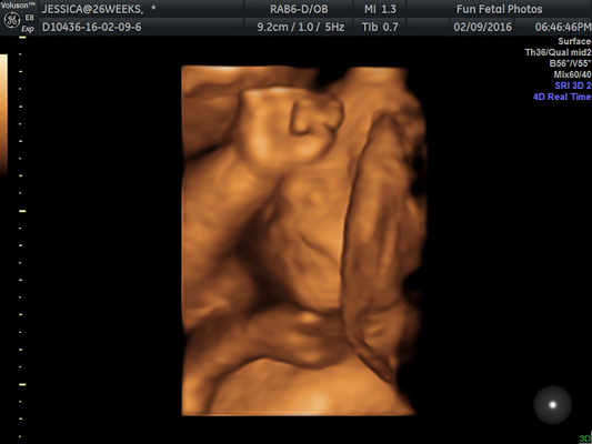 Fun Fetal Photos 3D Ultrasound prenatal imaging