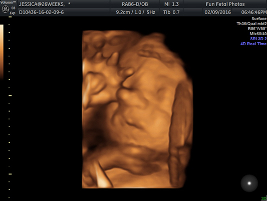 Fun Fetal Photos 3D Ultrasound prenatal imaging