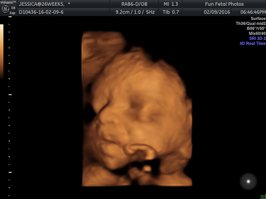 Fun Fetal Photos 3D Ultrasound prenatal imaging