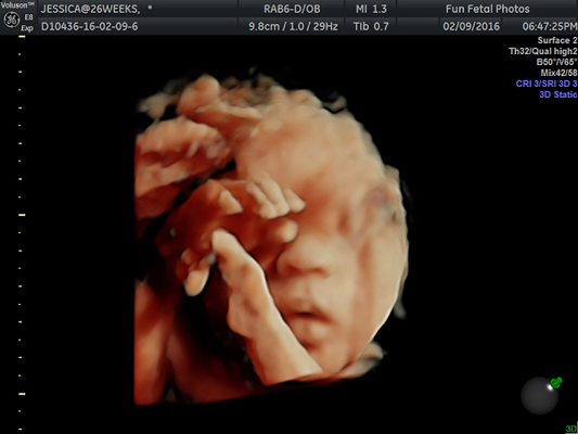 Fun Fetal Photos 3D Ultrasound prenatal imaging