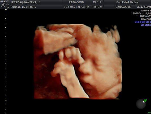 Fun Fetal Photos 3D Ultrasound prenatal imaging