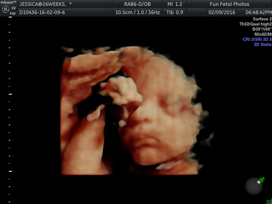 Fun Fetal Photos 3D Ultrasound prenatal imaging