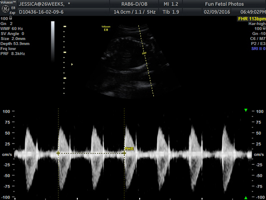 Fun Fetal Photos Prenatal Heartbeat Sound