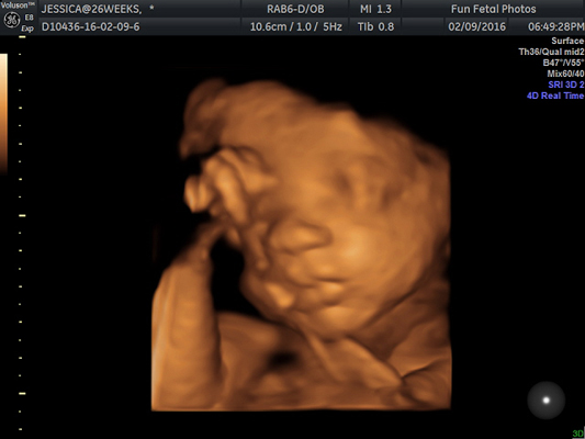 Fun Fetal Photos 3D Ultrasound prenatal imaging