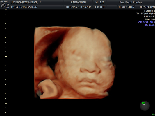 Fun Fetal Photos 3D Ultrasound prenatal imaging