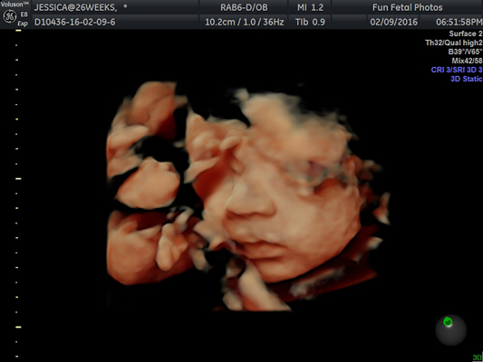 Fun Fetal Photos 3D Ultrasound prenatal imaging