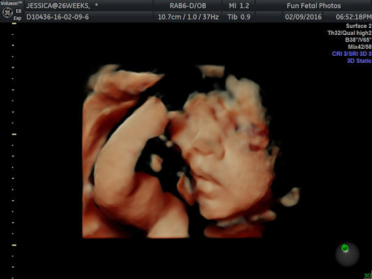 Fun Fetal Photos 3D Ultrasound prenatal imaging