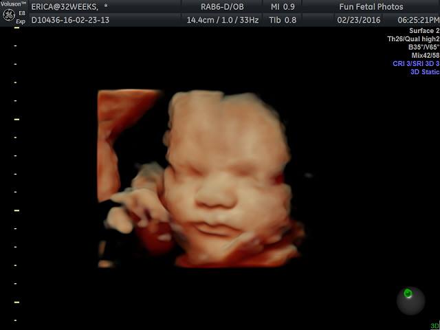 Fun Fetal Photos 3D Ultrasound prenatal imaging