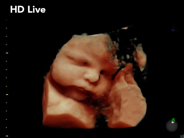 HD Live Ultrasound