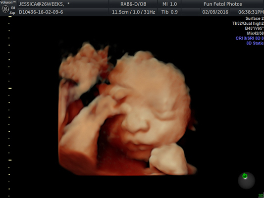 Fun Fetal Photos 3D Ultrasound prenatal imaging