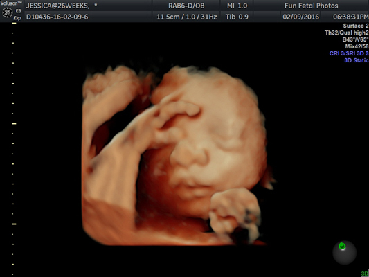 Fun Fetal Photos 3D Ultrasound prenatal imaging
