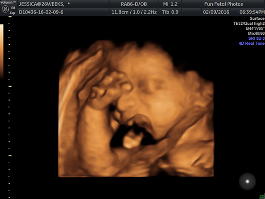 Fun Fetal Photos 3D Ultrasound prenatal imaging