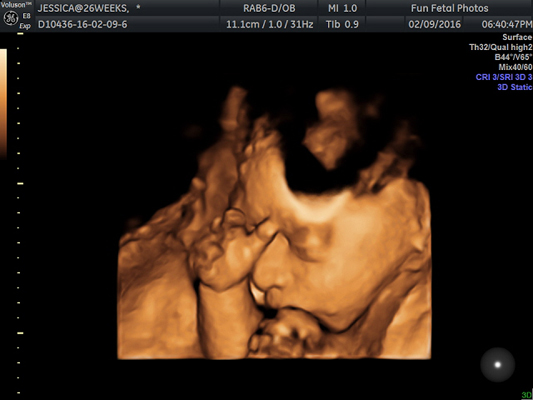 Fun Fetal Photos 3D Ultrasound prenatal imaging