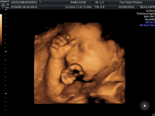 Fun Fetal Photos 3D Ultrasound prenatal imaging