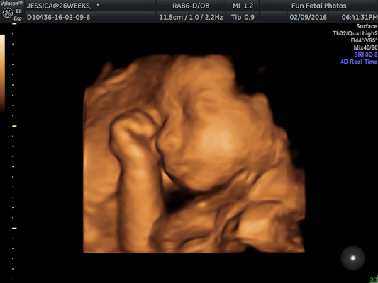 Fun Fetal Photos 3D Ultrasound prenatal imaging