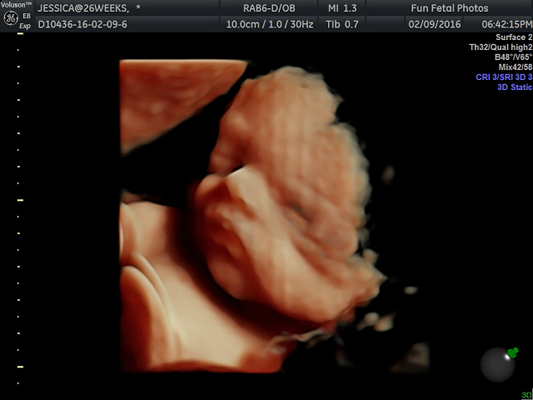 Fun Fetal Photos 3D Ultrasound prenatal imaging