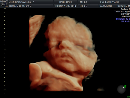 Fun Fetal Photos 3D Ultrasound prenatal imaging