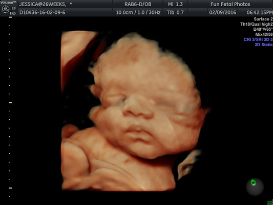 Fun Fetal Photos 3D Ultrasound prenatal imaging