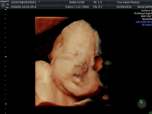 Fun Fetal Photos 3D Ultrasound prenatal imaging