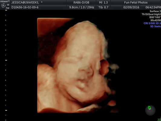 Fun Fetal Photos 3D Ultrasound prenatal imaging