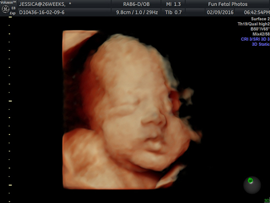 Fun Fetal Photos 3D Ultrasound prenatal imaging