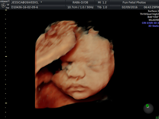 Fun Fetal Photos 3D Ultrasound prenatal imaging