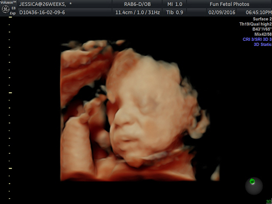 Fun Fetal Photos 3D Ultrasound prenatal imaging