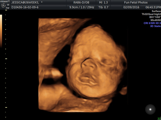 Fun Fetal Photos 3D Ultrasound prenatal imaging