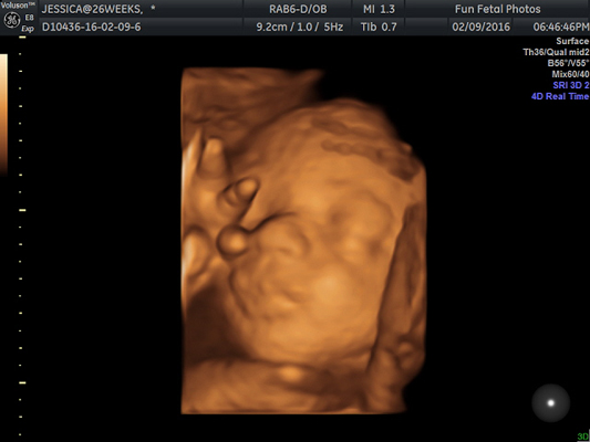 Fun Fetal Photos 3D Ultrasound prenatal imaging