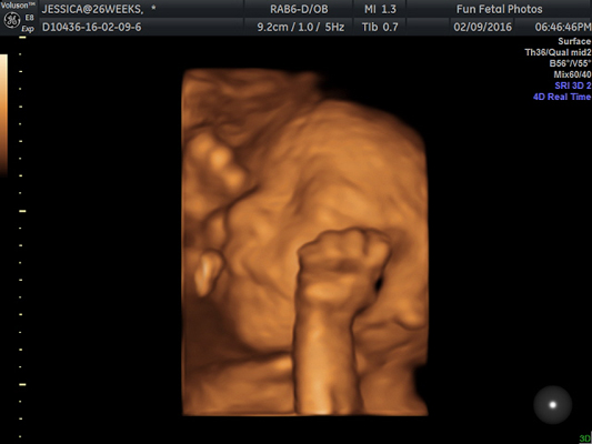 Fun Fetal Photos 3D Ultrasound prenatal imaging