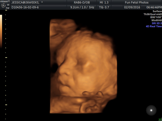 Fun Fetal Photos 3D Ultrasound prenatal imaging