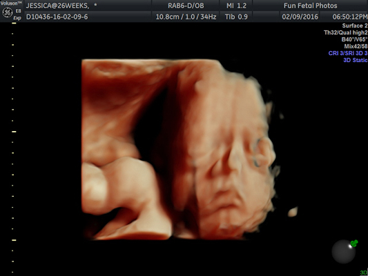 Fun Fetal Photos 3D Ultrasound prenatal imaging