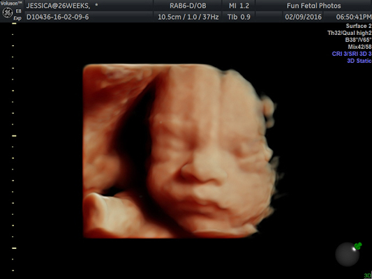 Fun Fetal Photos 3D Ultrasound prenatal imaging