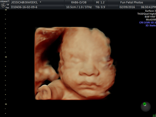 Fun Fetal Photos 3D Ultrasound prenatal imaging
