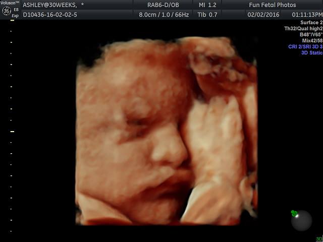 Fun Fetal Photos 3D Ultrasound prenatal imaging