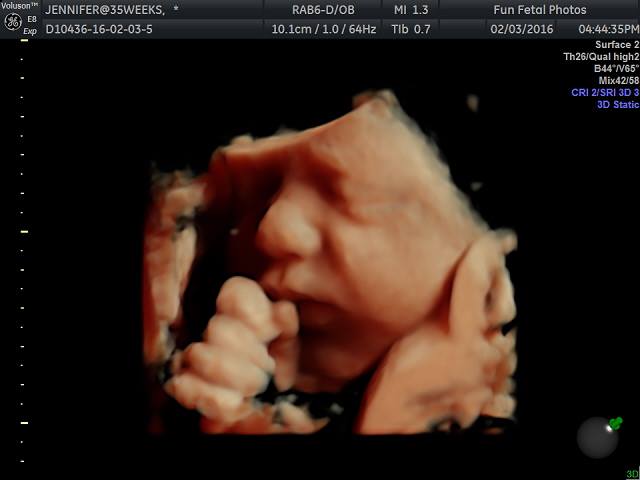 Fun Fetal Photos 3D Ultrasound prenatal imaging