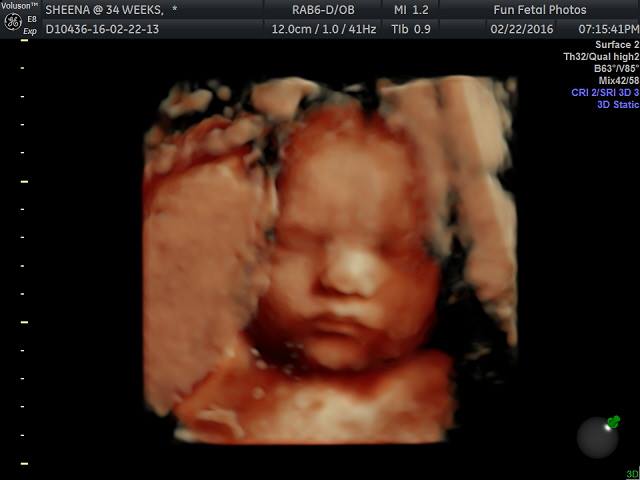 Fun Fetal Photos 3D Ultrasound prenatal imaging